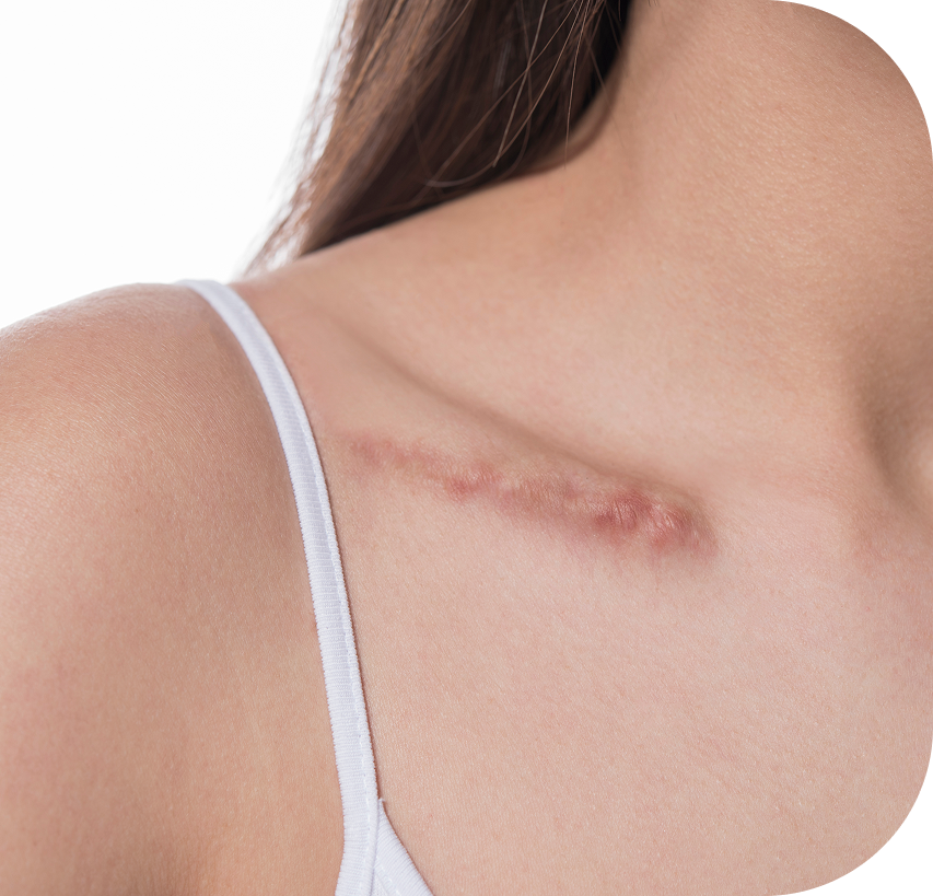 woman-showing-surgery-scar-scars-removal